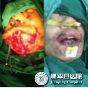 口腔颌面外科成功开展面部多组织